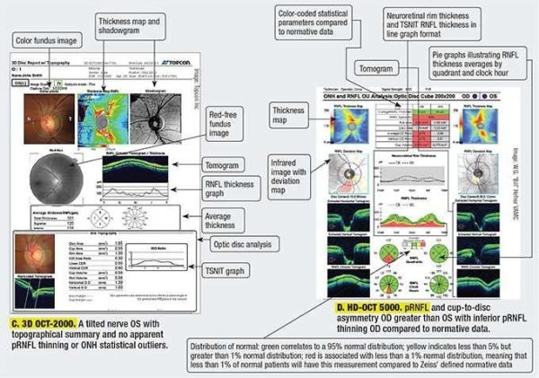 CARL ZEISS Cirrus HD-OCT 5000 OCT Imaging